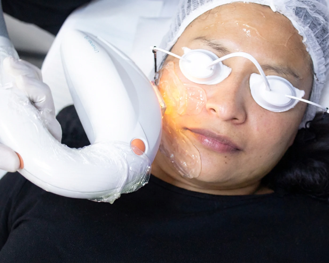 Luz pulsada intensa · Haut Klinik