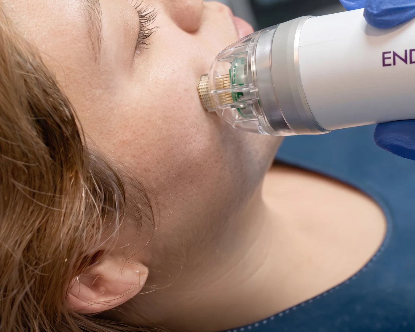 Microagujas Endymed · Haut Klinik