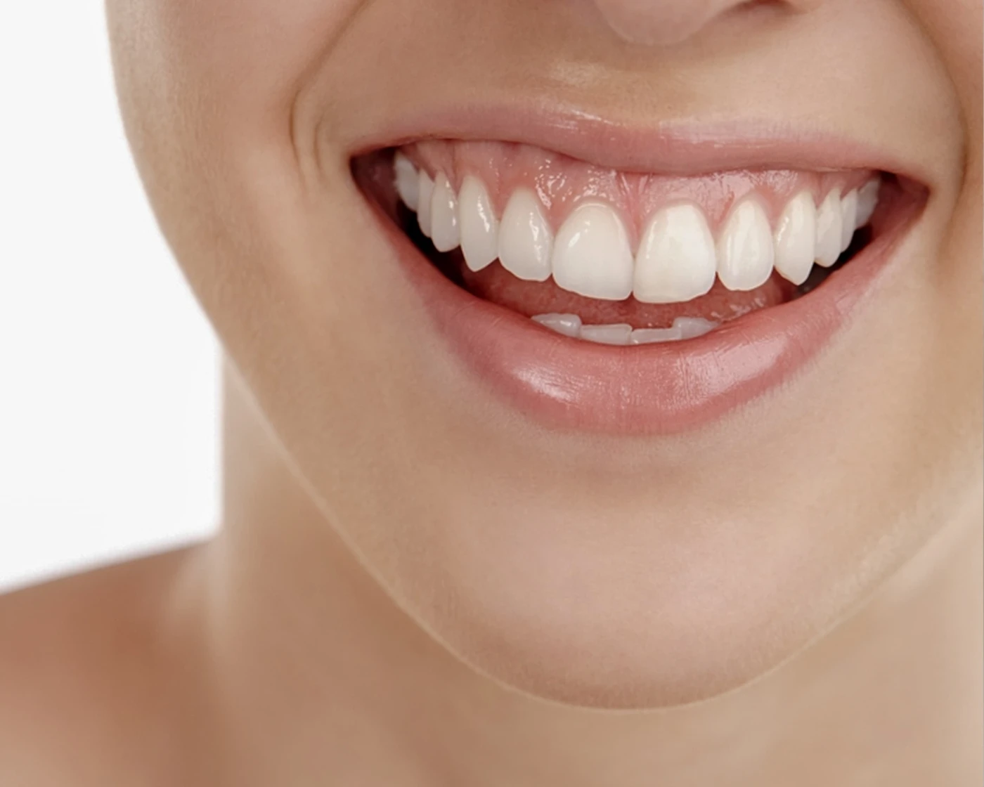 Botox sonrisa gingival · Haut Klinik
