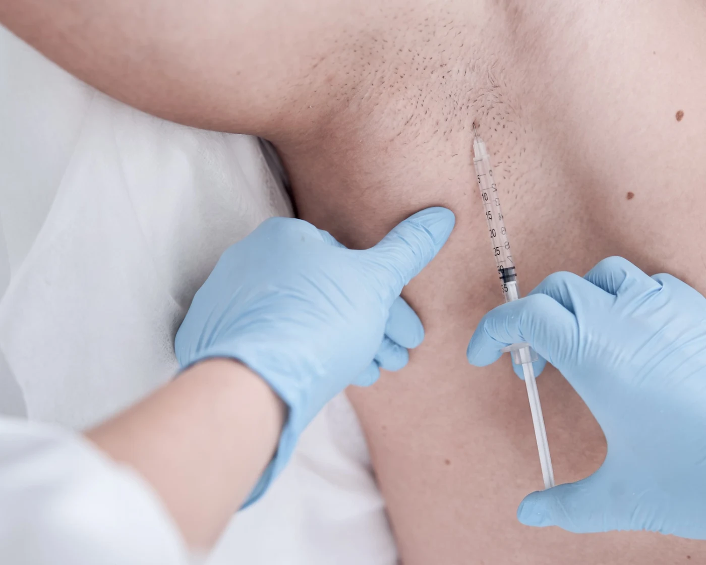 Hiperhidrosis · Haut Klinik